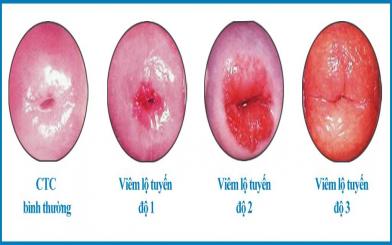 Tổng hợp hình ảnh viêm lộ tuyến cổ tử cung qua các cấp độ
