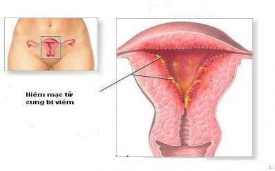 Tìm hiểu về bệnh viêm nội mạc cổ tử cung