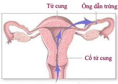 Hình ảnh viêm ống dẫn trứng ở nữ giới