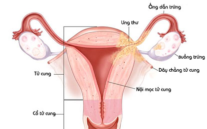 Phương pháp điều trị viêm nội mạc cổ tử cung
