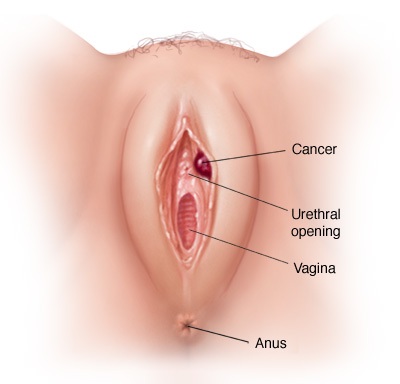 Polyp âm đạo là hiện tượng có các khối u ở thành âm đạo
