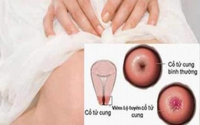 Viêm lộ tuyến cổ tử cung là gì và sự nguy hiểm của bệnh