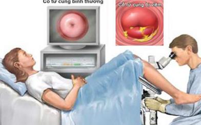 Phác đồ điều trị viêm cổ tử cung hiệu quả nhất Hà Nội
