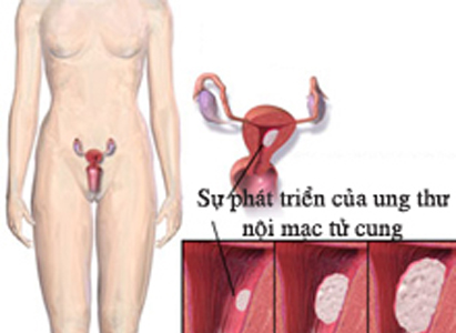 Bệnh viêm nội mạc tử cung có chữa khỏi được không