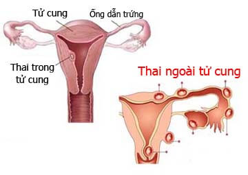 Thai ngoài tử cung